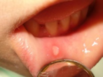Aphthous stomatitis sa isang bata