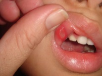 Aphthous stomatitis sa isang bata