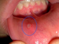 Aphthous stomatitis sa isang bata