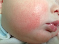 Child diathesis