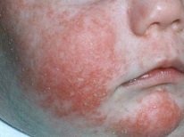 Child diathesis