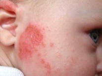 Child diathesis
