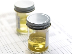 General urine analysis in children: transcript in the table