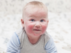 Atopic dermatitis pada kanak-kanak