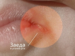 Ангулит в ъглите на устата при деца