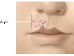 Impetigo bei Kindern