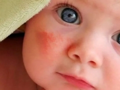 Dermatit çocuklarda nasıl görünür?