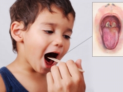 Mga sintomas, paggamot at pag-iwas sa dipterya sa mga bata