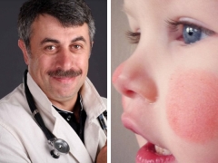 الدكتور كوماروفسكي عن الخدين الحمراء في الطفل