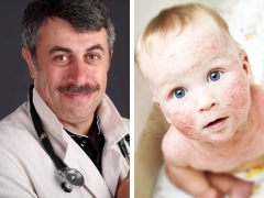 Dr Komarovsky mengenai rawatan dermatitis atopik pada kanak-kanak