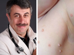 Dr Komarovsky mengenai rawatan kanak-kanak dengan molluscum contagiosum