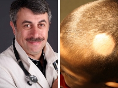 Dr. Komarovsky, çocuklarda saç dökülmesinin nedenleri hakkında