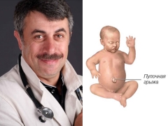 Komarovsky yenidoğanlarda ve küçük çocuklarda göbek fıtığı hakkında
