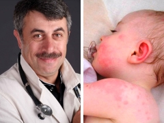 Dr. Komarovsky mengenai roseola