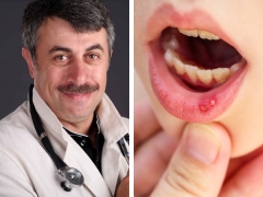 Si Dr. Komarovsky tungkol sa stomatitis