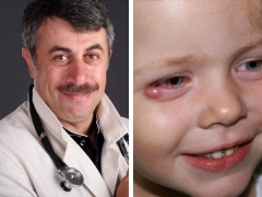 Dr Komarovsky sa kung paano gumamot barley sa mga mata ng isang bata