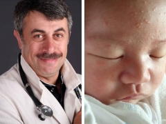 Dr. Komarovsky tentang jerawat pada bayi baru lahir