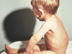 Rickets pada bayi: gejala dan rawatan