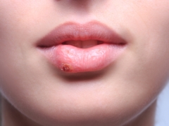 Çocuklarda herpes semptomları ve tedavisi