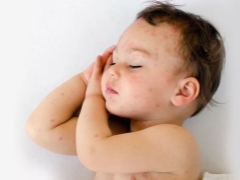Why did the child have a rash and what to do?