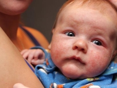 Staphylococcus aureus bei Kindern