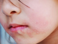 E se houver irritação ou erupção na boca da criança?