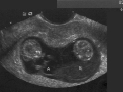 What is fetal CTP, and how should it be normal during pregnancy?
