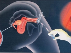 Was ist eine intrauterine Insemination und wie wird das Verfahren durchgeführt?