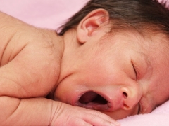 Lanugo in newborns