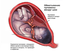 Опасно ли е да заплитате пъпната връв около врата на плода и как то засяга раждането?