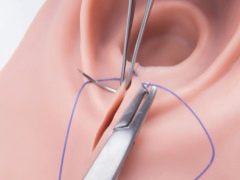 Epiziorrhaphy nedir ve doğumda ne zaman kullanılır?