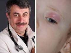 Dr. Komarovsky mengenai rawatan chalazion pada kanak-kanak