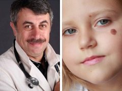 Dr Komarovsky mengenai tahi lalat di kalangan kanak-kanak