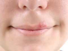 Herpes-Psychosomatik bei Kindern und Erwachsenen