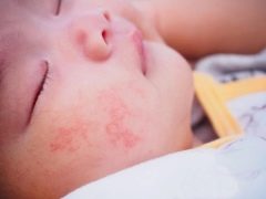 Urtikaria pada bayi: dari gejala hingga rawatan