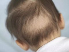 Ang buhok ay nahuhulog sa mga sanggol: ang mga sanhi at ang kanilang pag-aalis