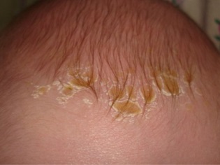 Head hair diathesis