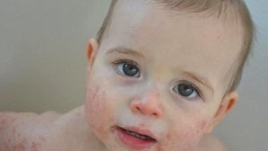 Atopik dermatitli çocuklar için merhem