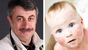 Dr Komarovsky sa paggamot ng atopic dermatitis sa mga bata