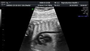 Biochemical screening in the first trimester
