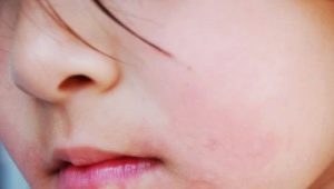 E se houver irritação ou erupção na boca da criança?