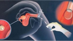 Apakah inseminasi intrauterin dan bagaimana tatacara dilakukan?