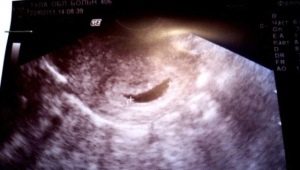 Punca dan kesan ubah bentuk ovum