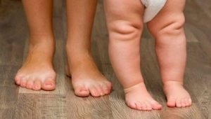 التدليك والتمرين ل clubfoot في الأطفال