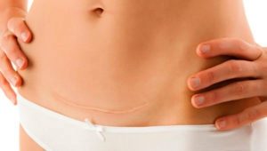 How to lose weight after cesarean section?