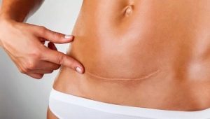 What if the suture after a cesarean section?