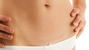 How long does the discharge go after cesarean section and what does it depend on?