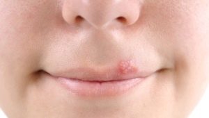 Psychosomatics ng herpes sa mga bata at matatanda