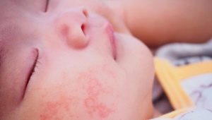 Urticaria sa mga sanggol: mula sa mga sintomas hanggang sa paggamot