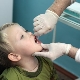 التطعيم ضد شلل الأطفال
